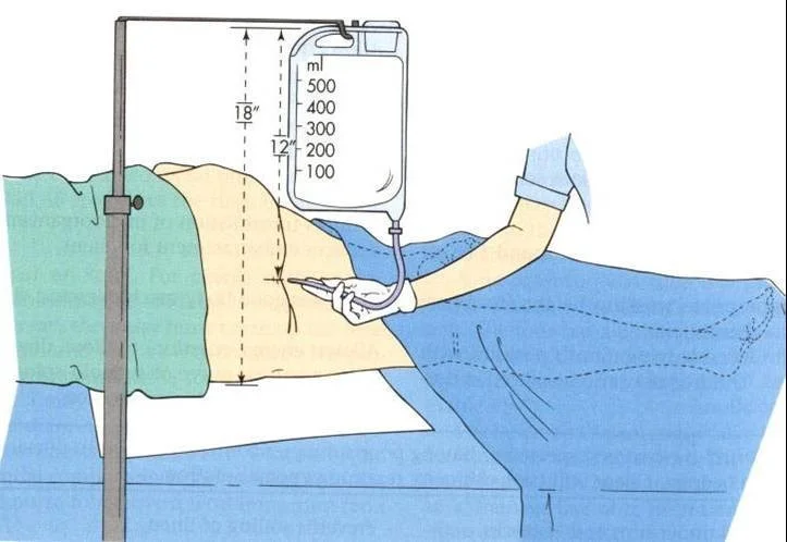 Thụt tháo đại tràng là gi? Vì sao không nên thực hiện tại nhà?